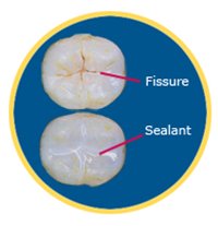 fissue and dental sealant